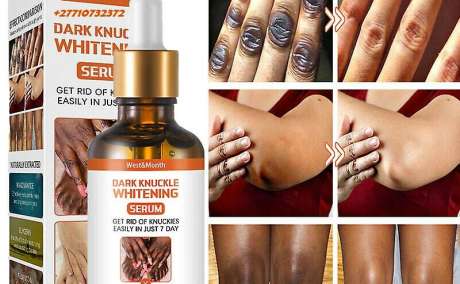Dark Knuckle Whitening Serum In Marousi City in Greece, Hand Elbow Knee Brightening Serum In Polokwane City And Saldanha Town Call ☏ +2771 073 2372 Get Rid Of Scars And Stretch Marks In Johannesburg South Africa And Edsbruk Municipality in Sweden